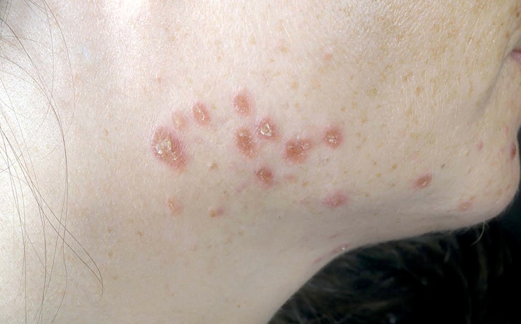 Skin Disorders
